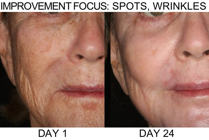 spots-wrinkles-2